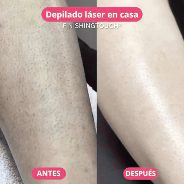 Zayle™ | Depiladora Láser Corporal